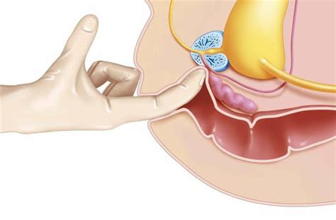 Reddit gives you the best of the internet in one place. Will a prostate massage reduce inflammation? - Quora