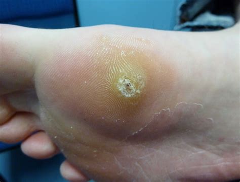 Plantar Wart Side Of Foot at Edward Yuan blog