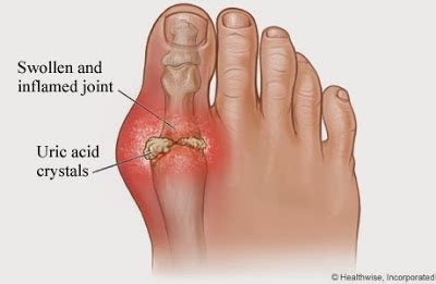 Batu asid urik boleh terbentuk bagi orang yang tidak minum cecair yang mencukupi atau yang batu kalsium juga boleh berlaku dalam bentuk kalsium fosfat. Blog Tasly Sabah : KENALI TANDA-TANDA GOUT