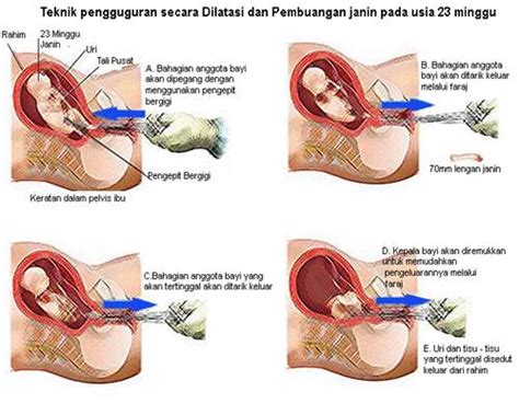 Obat tradisional infeksi rahim ::infeksi rahim merupakan salah satu penyakit yang menggangu sistem reproduksi wanita yang terjadi atau timbul disebabkan secara umum penyakit infeksi rahim ini mempunyai tiga tingkatan yakni ringan, sedang, dan berat. Wanti Sayang Postnatal Care: KEGUGURAN