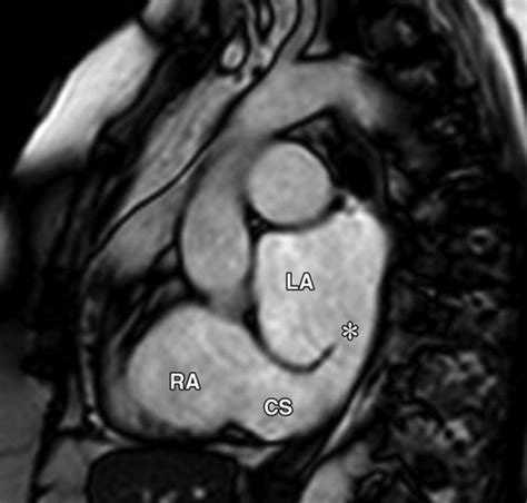Each cavernous sinus has a close anatomical relationship with several key structures in the head. Imaging of the Coronary Sinus: Normal Anatomy and ...