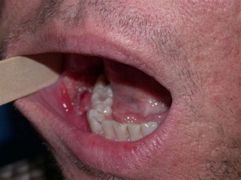 These fat deposits show up mostly on the legs, trunk and arms, explains eileen s. Medical Pictures Info - Throat Cancer