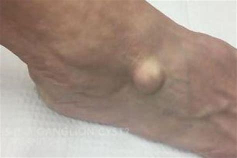 Cette vidéo parle du cancer. Une mystérieuse boule apparue sur son pied, il se rend ...
