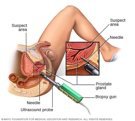 7.1 what to focus on Prostate cancer - Diagnosis and treatment - Mayo Clinic