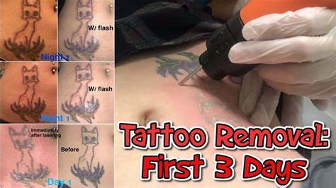 The price of a laser tattoo removal is often based on the size, location, and intricacy of the tattoo design. Tattoo Removal // First 3 Days // Why, How Much Did It ...