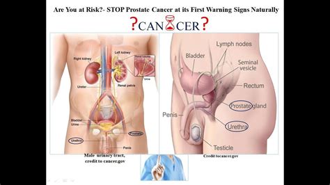 What doctors say you need to know. Are you at Risk STOP Prostate Cancer at its First Warning ...