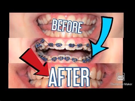 You might want to consider them when you're past the teenage years for a number of reasons. Braces timelapse! - YouTube