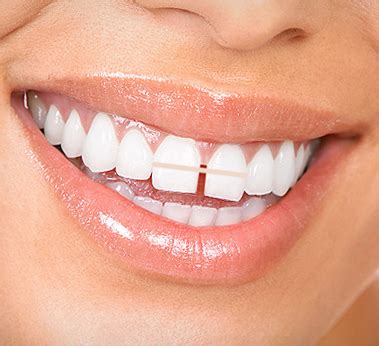 Cosmetic dentists worn about new gaps appear on the sides of the moved teeth. Pin on Beauty Tips