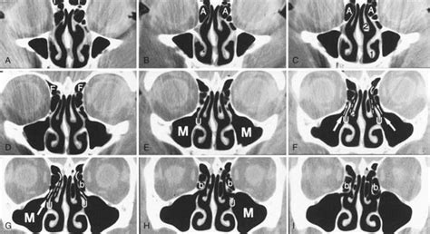 In this review we present the normal axial and coronal anatomy of the temporal bone by scrolling through the images. Ct Sinus Anatomy - Anatomy Drawing Diagram