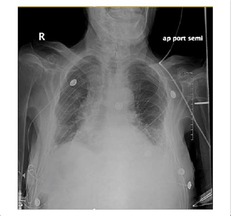 Ap upright and lateral views of the. Chest X-ray showing bilateral bibasilar infiltrates with ...