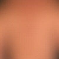Die ursache ist unklar und sie tritt häufiger bei kinder schwarzer hautfarbe auf. Bilder für Rumpf, rot - Altmeyers Enzyklopädie