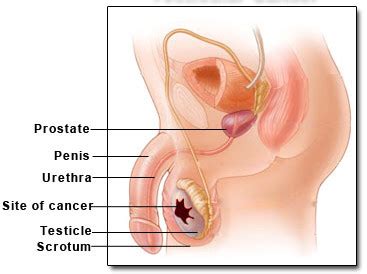 Cryptorchidism literally means hidden or obscure testis and generally refers to an undescended or maldescended testis. Testicular Cancer - Symptoms and Signs