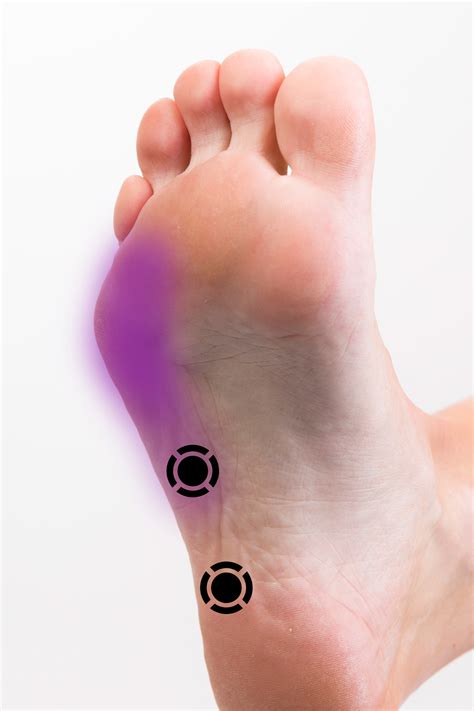 Abductor digiti minimi (foot) (wikipedia). Abductor Digiti Minimi (Foot) Summary - Komizo Diagnostics