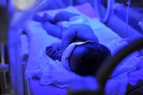 Prolonged neonatal jaundice is said to be present if the jaundice persists for longer than 14 days in term infants and 21 days in preterm infants. Kenali Tingkat Bilirubin Normal pada Bayi Baru Lahir ...