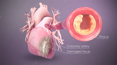 A nanotech detector for heart attacks: Myocardial Infarction (Heart Attack): Symptoms, Causes ...