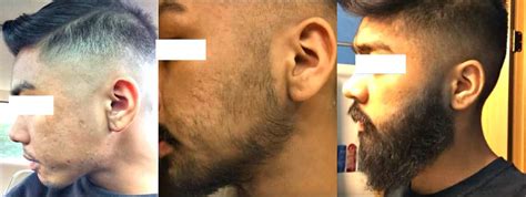 Your personal journey is going to dictate when you should stop using minoxidil, and that is generally when you are happy with the growth of your beard. Cerafill Retaliate Before And After