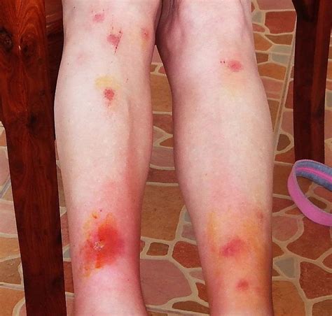 Mosquito bites are often just itchy and uncomfortable, but they could lead to something much worse. 77 best images about Skeeter Syndrome Pictures on ...