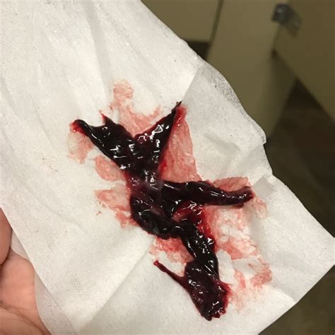 Up to half of all pregnancies result in a miscarriage, often before the woman is even aware that she has conceived. Blood clot or miscarriage?? About 3 inches in length - Glow Community