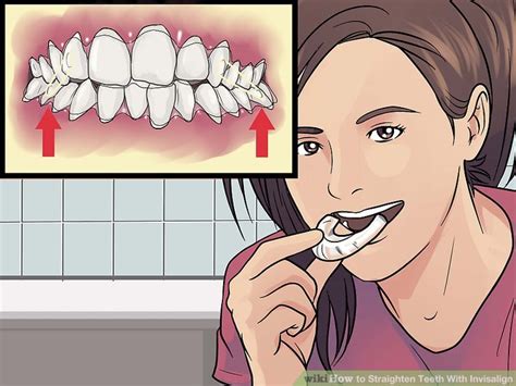 You can't simply wear a retainer to sleep every night or use someone else's retainer to straighten your teeth without braces. How to Get Straight Teeth Without Braces with Invisalign ...