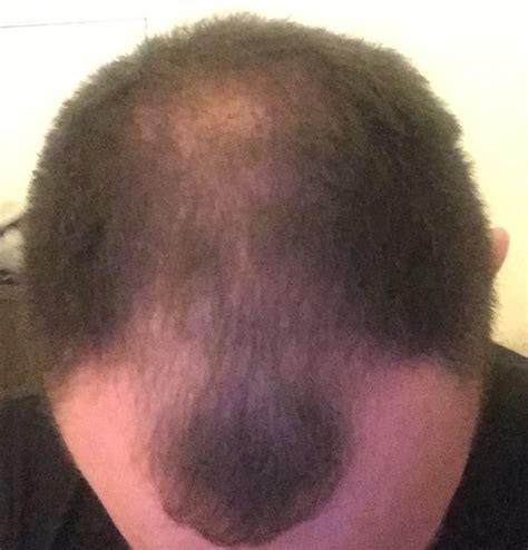 Pattern hair loss and heart disease: Minoxidil, Dermaroller So Far So Good 5 Weeks (pictures ...