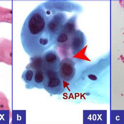 جديد بله ودالاشبه أدو فرصه للعشاق 2020. Lsil Cytology - Cytopathology | GLOWM / Cytology until ...