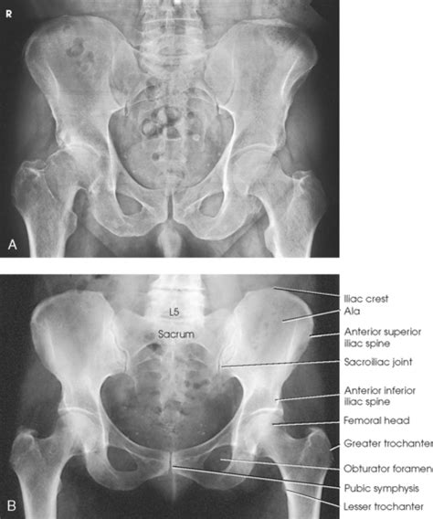 This causes the sides of the. Male Pelvis Vs Female Pelvis Radiology - slidedocnow