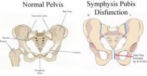 Infact, it affects up to one in five pregnant women. What You Need To Know About SPD in Pregnancy - World For ...
