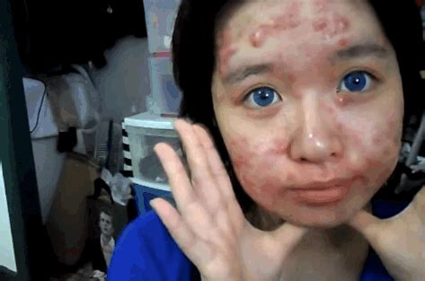 Muka breakout teruk bagus ke klu pergi jumpa doctor загрузил: Stress Dengan Kulit Wajah Breakout Teruk, Gadis Ini Pilih ...