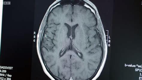 La esclerosis múltiple (em) es una enfermedad neurológica; El hombre que se recuperó de una enfermedad incurable con ...