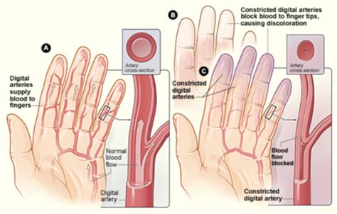 So zeigt sich sich eine durchblutungsstörung der hände. Raynaud-Syndrom - DocCheck