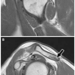(PDF) Stress injury of the acromion: Case report and ...