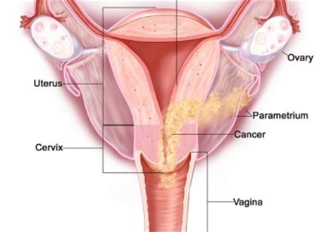 Endometrial cancer is cancer of the endometrium. Endometrial Cancer. Causes, symptoms, treatment ...