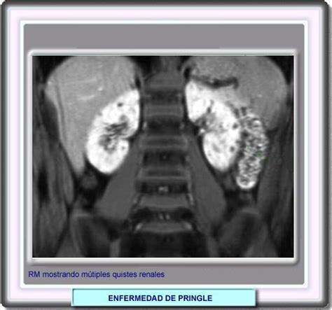 Para tí que tienes esclerosis múltiple, ¿cuéntame 3 de las cosas más difíciles con esta enfermedad? • ENFERMEDAD DE PRINKLE