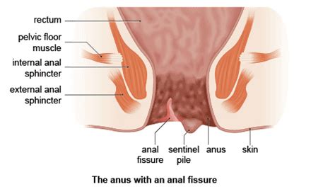 No annoying ads and a better search engine than pornhub! MEDICINE: ANAL FISSURE