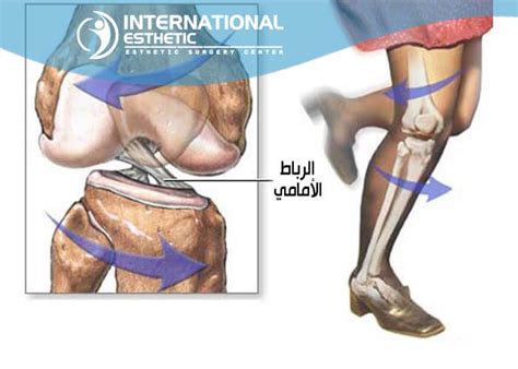 There are two types of acls: عملية الرباط الصليبي , تطور العمليات الجراحيه - المميز