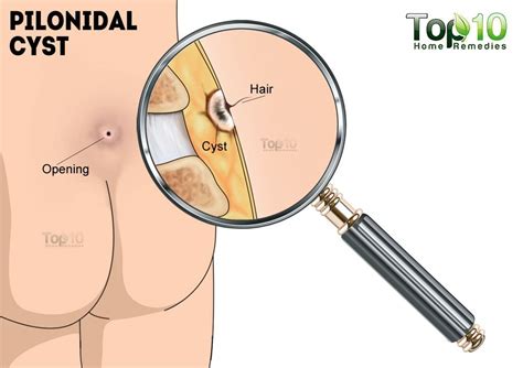 From a hair removal standpoint, the butt area can be treated similarly to the legs, says dr you've got options, though, including laser hair removal. Home Remedies for Pilonidal Cysts (Large Pimple at Bottom ...