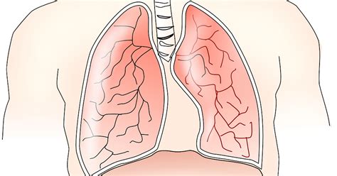 Pleural mesothelioma is the most common form of the cancer, and affects the tissue lining the lungs and chest cavity. Peritoneal Mesothelioma - Causes, Symptoms, Diagnosis ...