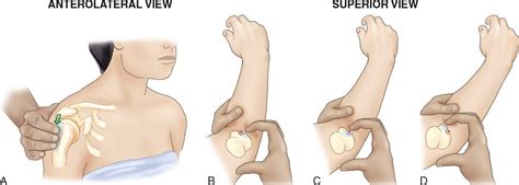Lesser tuberosity).—the lesser tubercle, although smaller, is more prominent than the greater: 5. Bony Palpation | Musculoskeletal Key