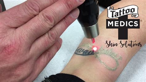 The most common observable effects that you may experience during your laser tattoo removal aftercare process include mild swelling across the treated area, as well as some redness. Laser Tattoo Removal Treatment at TattooMedics Skin ...