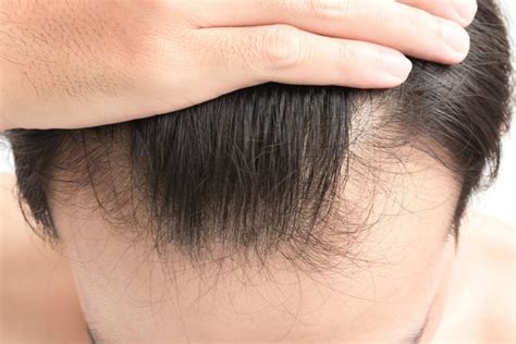 Pressure in the back of your head. 7 Simple Ways To Help Prevent Hair Loss In Men - Fitneass