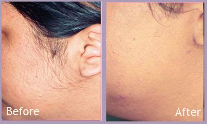 You can find them in every nook and corner. Before and After Laser Hair Removal | St. Louis Cosmetic ...