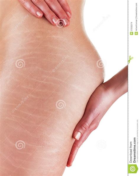 Stretch marks usually appear when you follow an intense workout and bodybuilding routine and rapidly build muscle mass on your biceps and shoulders. Stretch Marks And Cellulite Stock Images - Image: 37532274
