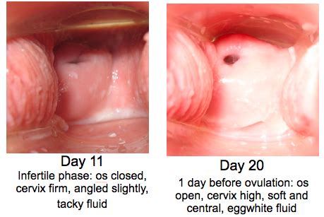 Wide open, slightly open, or squeezed shut? Cervical Position & Cervical Changes During the Menstrual ...