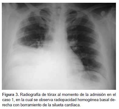 Algunas bacterias piógenas en cualquier parte del cuerpo pueden causar miocarditis. SciELO - Saúde Pública - Peste neumónica primaria con ...