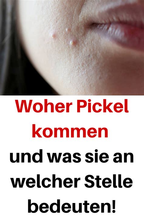 Veröffentlicht am 18.09.1997 | lesedauer: Woher Pickel kommen und was sie an welcher Stelle bedeuten ...