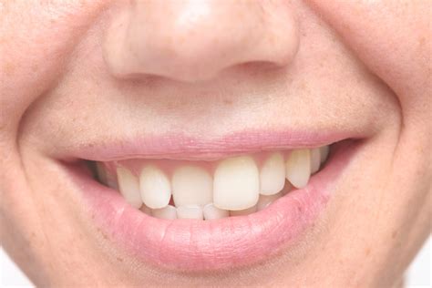 They require more work and planning than dental bonding, but. Straighten Crooked Teeth Without Braces | Silver Spring MD
