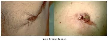 Breast cancer in men is a rare disease. Male breast cancer
