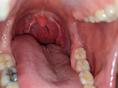 Because most people do not. Left sided throat pain 2+ weeks, left submental lymph node ...