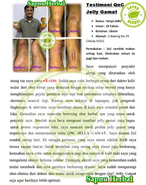 Cara Menghilangkan Keloid di Bibir Secara Alami dan Cepat ...