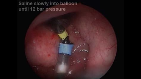 About 1/3 of its length is bony (this portion enters into the middle ear), and about 2/3 cartilaginous (this portion enters the back of the nose and throat). Balloon dilation of Eustachian tube - YouTube